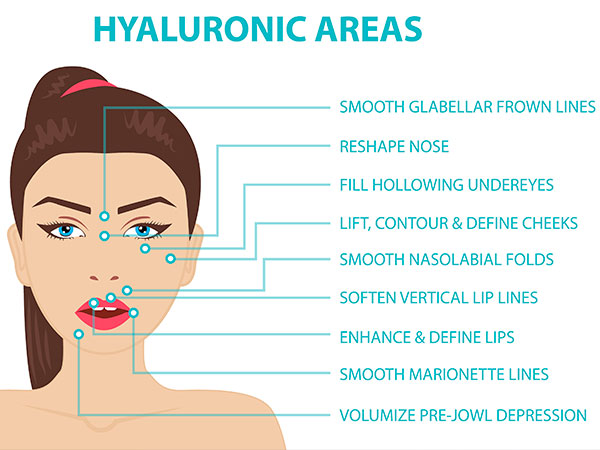 acido-hialuronico-areas-actuacion-rostro