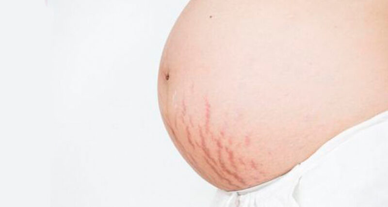 Comercio Embrión manguera Estrías rojas: tratamientos para eliminarlas y toda la información ✓ | Blog  Druni