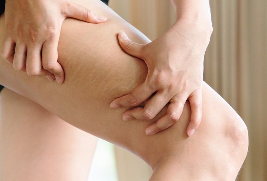 ¿Cómo evitar o prevenir la aparición de estrías blancas?