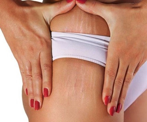 Estrías en las piernas