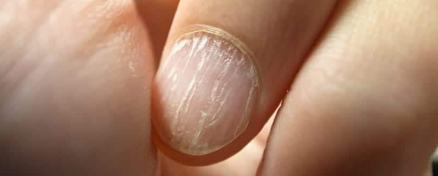 Cómo eliminar las estrías de las uñas  Las estrías de las uñas son causa  de falta de humectación además quienes tienen uñas débiles tienden a  sufrir mucho más con este mal