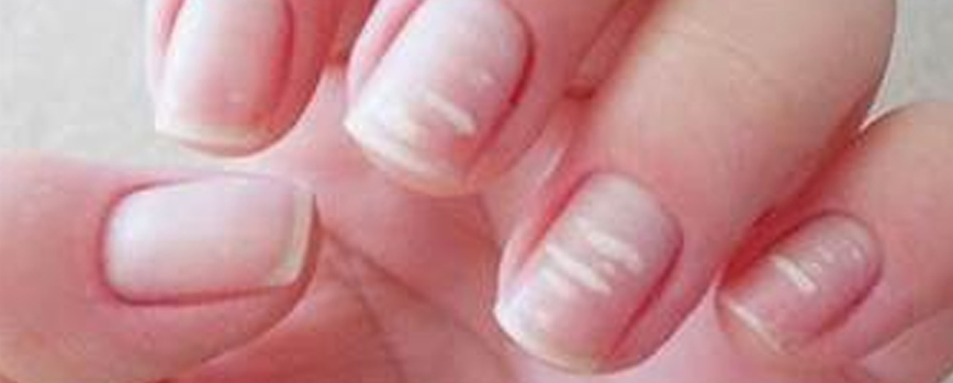llave inglesa Perversión rasguño Por qué aparecen las manchas blancas en las uñas? ✓ | Blog Druni