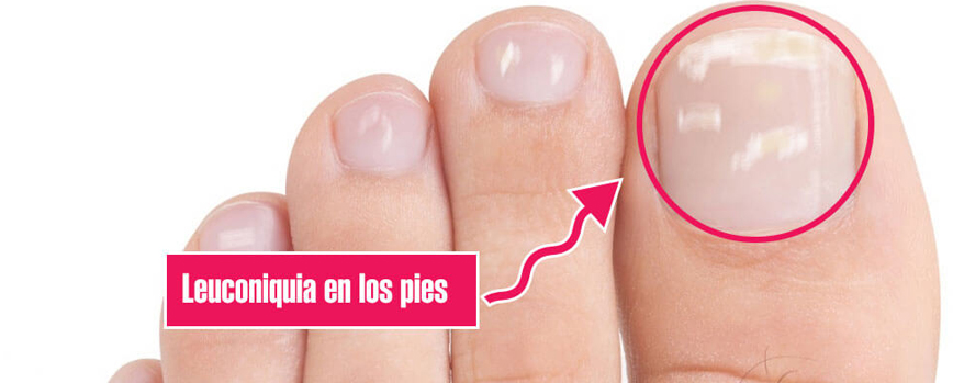 Escarpado Donación Posicionamiento en buscadores Por qué aparecen las manchas blancas en las uñas? ✓ | Blog Druni Escarpado Donación Posicionamiento en buscadores Por qué aparecen las manchas blancas en las uñas? ✓ | Blog Druni