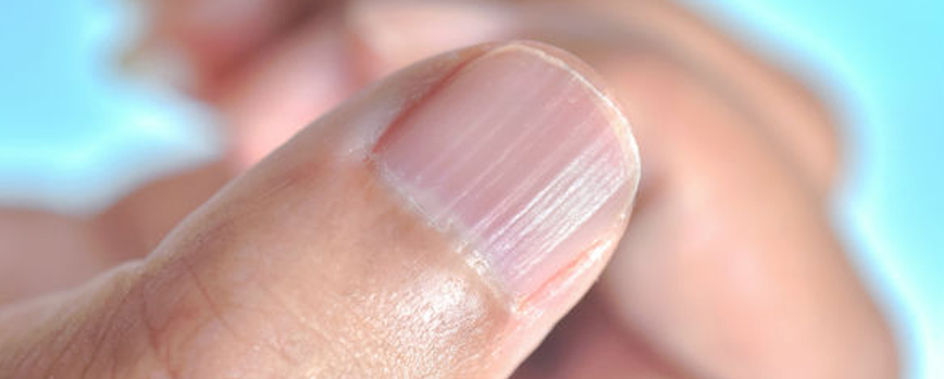 Uñas estriadas verticalmente