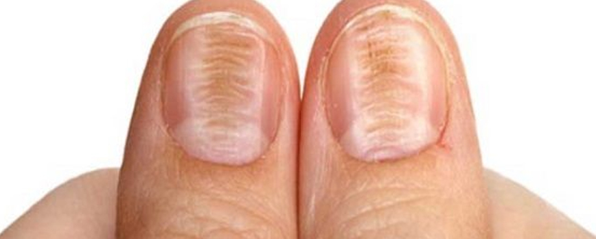 Uñas estriadas horizontalmente