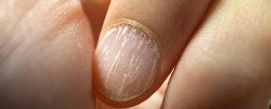 Uñas secas y estriadas