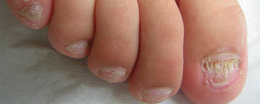 Cómo tratar las uñas estriadas paso a paso en función de sus causas