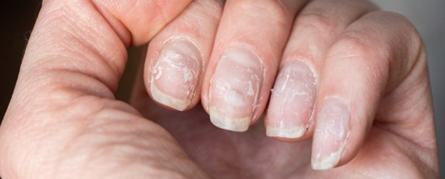 Uñas quebradizas y estriadas