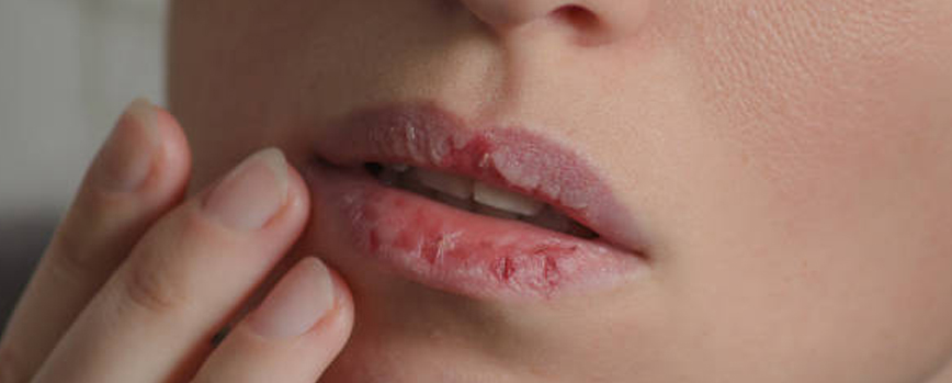 Labios secos: principales causas