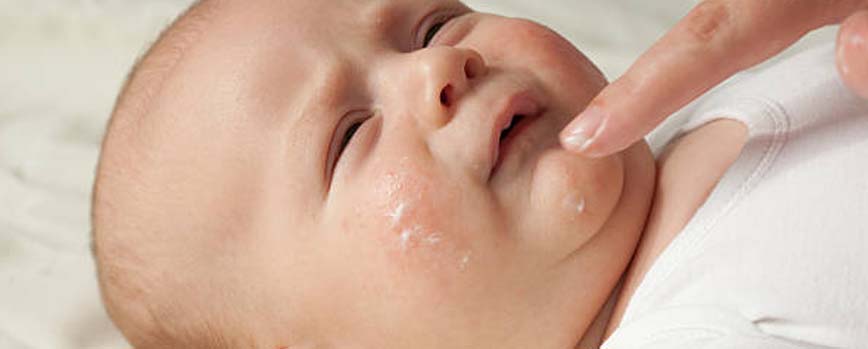 ¿Cómo tratar la dermatitis atópica en niños y bebés?
