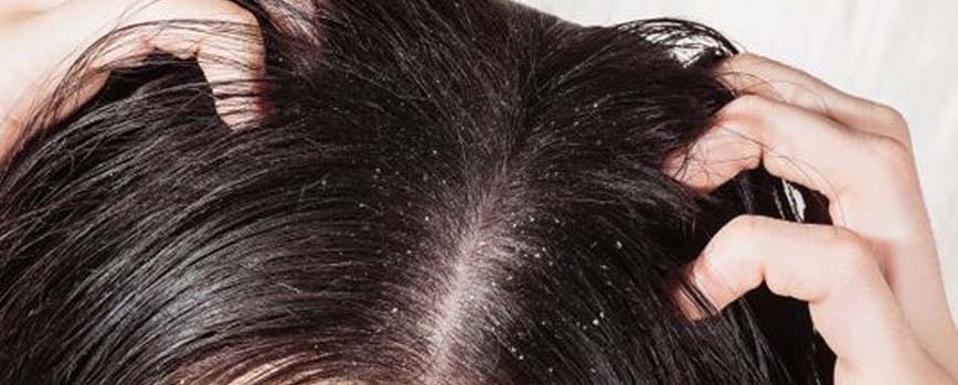 ¿Por qué sale caspa en el pelo?