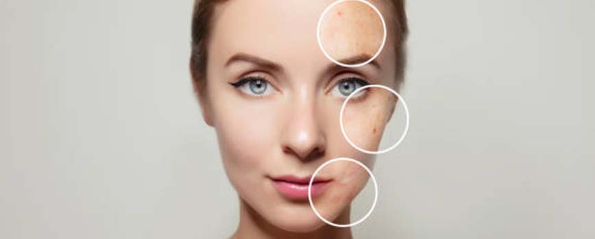 Síntomas de los tipos de acne facial