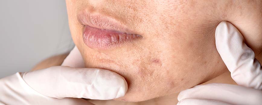 ¿Qué beneficios tiene la gluconolactona en la piel?