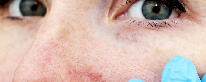 ¿Retinol o Bakuchiol?
