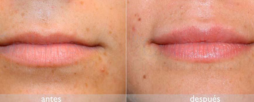 ¿Cuánto tiempo dura el aumento de labios con ácido hialurónico?