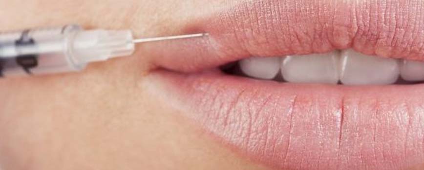 ¿Cómo es el procedimiento de aumentar los labios con ácido hialurónico?