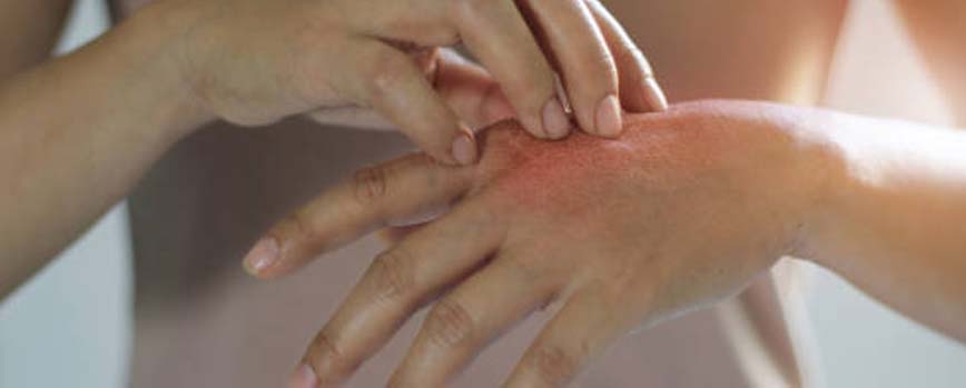Psoriasis