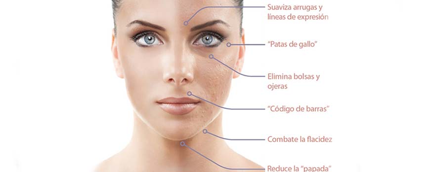 ¿Para quién esta recomendado la microdermoabrasión?