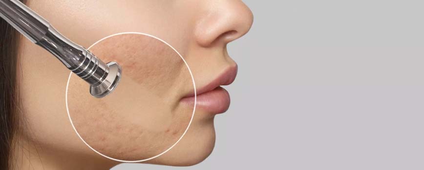 ¿Cómo preparar la piel para la microdermoabrasión?