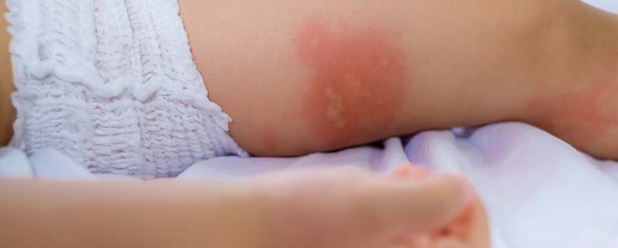 Heridas y picaduras