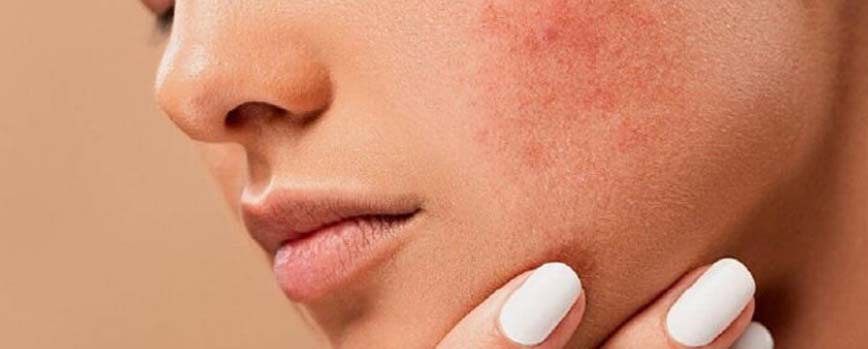 Contra la psoriasis y los eccemas