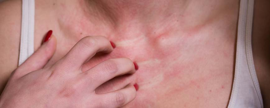 ¿Qué es la alergia al sol en la piel?