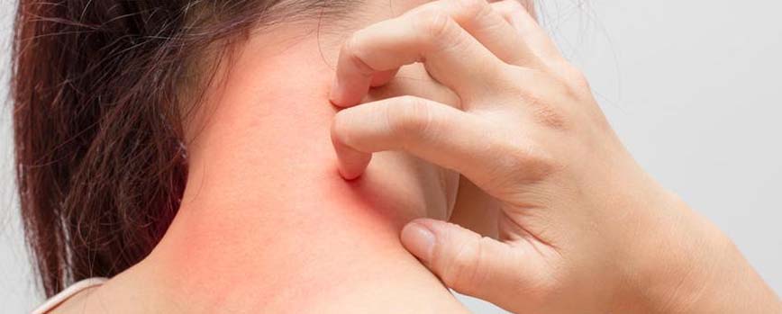 Síntomas de la alergia al sol
