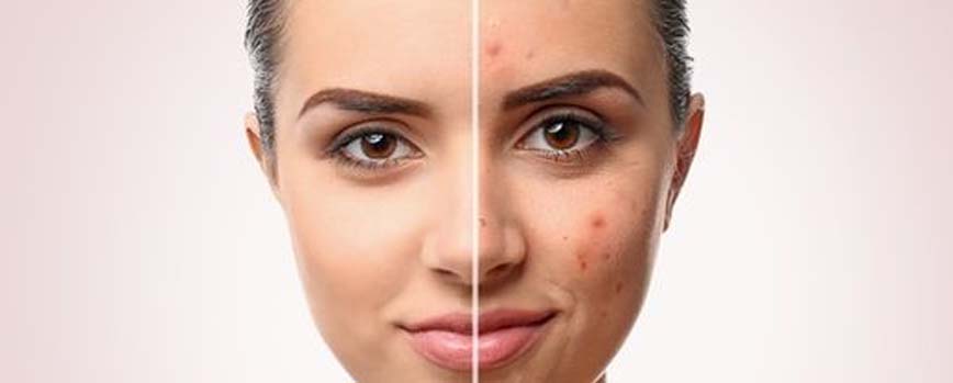 Bueno contra el acné, la psoriasis y los eczemas