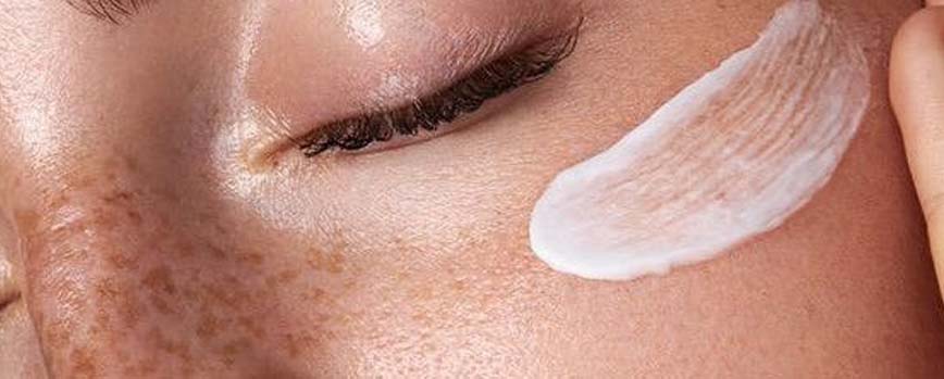 ¿Qué crema escoger para eliminar el acné?
