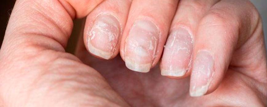 Desventajas de las uñas de porcelana
