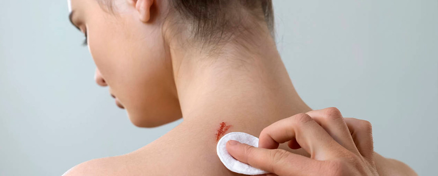 ¿Por qué usar una crema cicatrizante?
