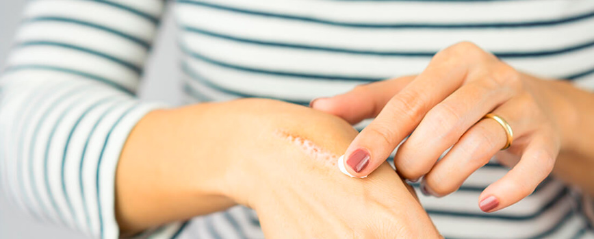 ¿Cuándo usar una crema cicatrizante?