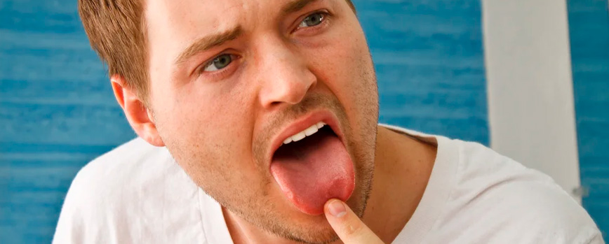¿Qué son las espinillas en la lengua?