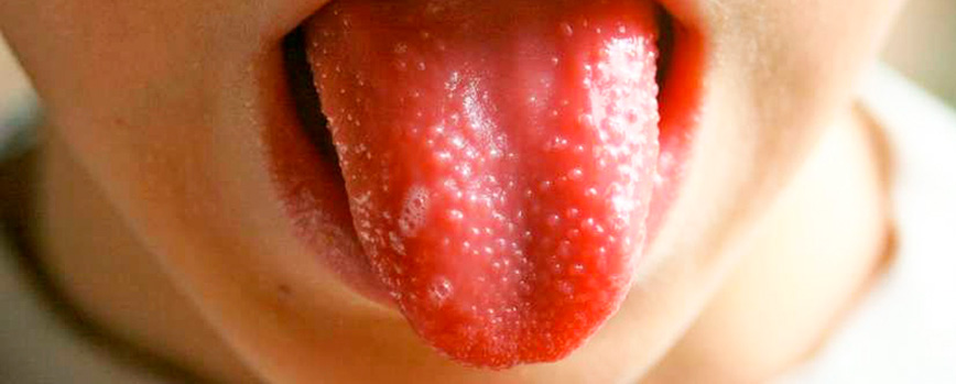 Granos blancos en la lengua
