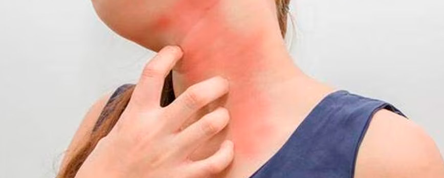 Alergia por contacto