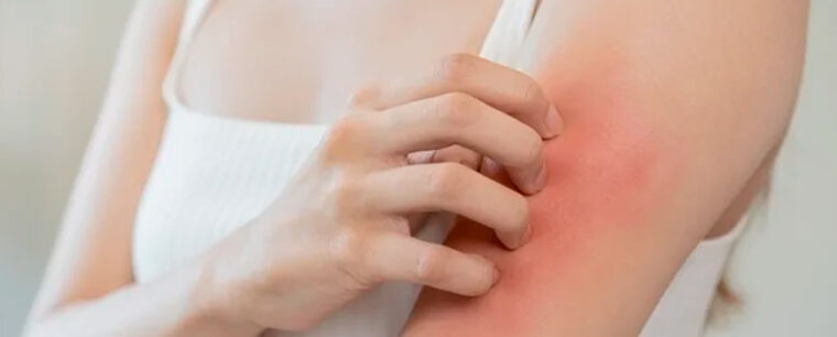 Me Pica Todo El Cuerpo Como Si Tuviera Bichos www.druni.es