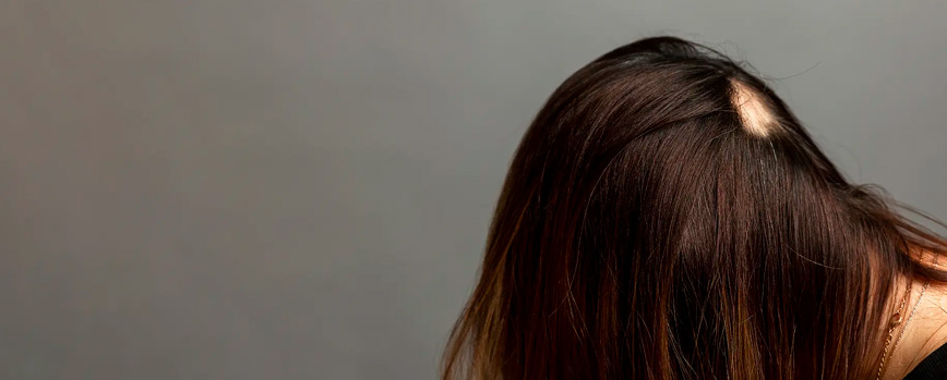 Causas de la alopecia areata en mujeres