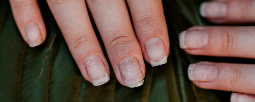 Causas del debilitamiento de las uñas