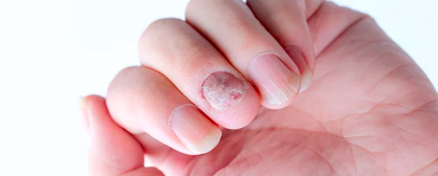 ¿Qué son los hongos de las uñas y cómo saber si los tienes?