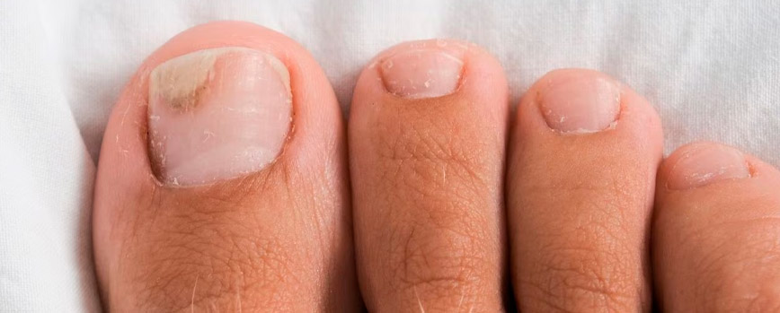 ¿Cómo se contraen los hongos en las uñas de los pies?