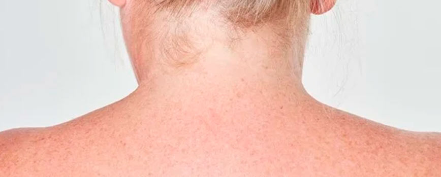 ¿Qué son las manchas en el cuello?