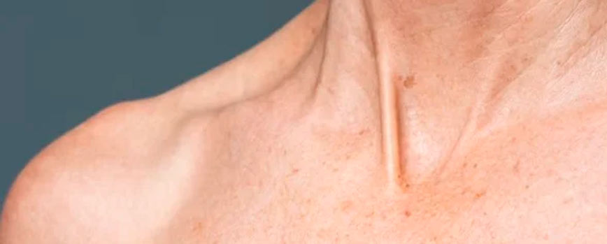 Causas de las manchas en el cuello