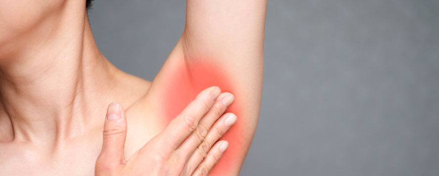 ¿Cuáles son los síntomas de la irritación de las axilas?