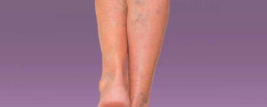 Si te pican las piernas podrías tener un problema dermatológico