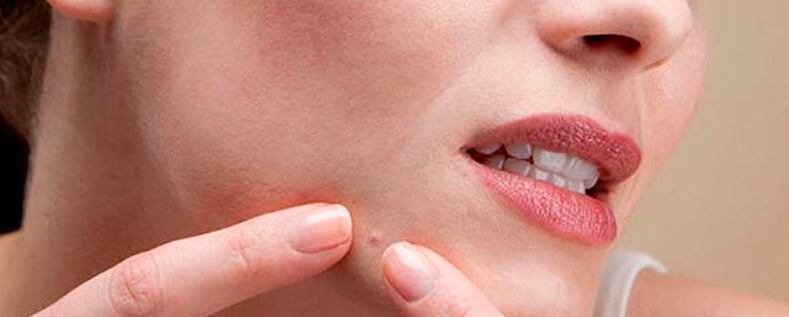 ¿Qué crema para los granos farmacia aplicarme?