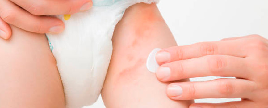 Causas de la dermatitis del pañal