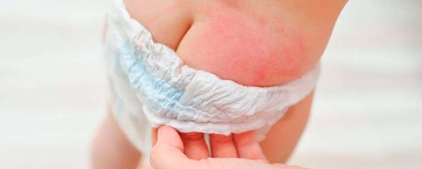 Síntomas de la dermatitis del pañal
