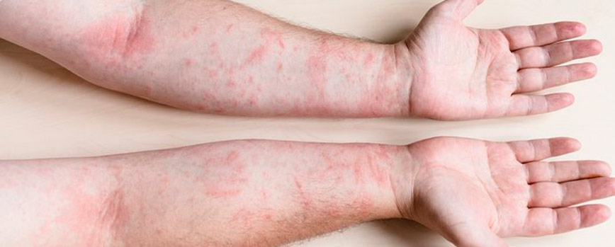 Dermatitis alérgica por contacto