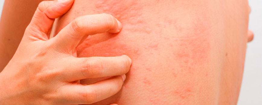 Urticaria