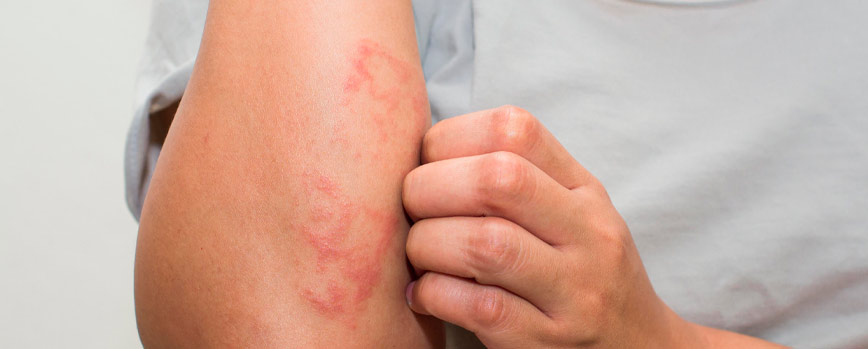 Eccema (dermatitis atópica)